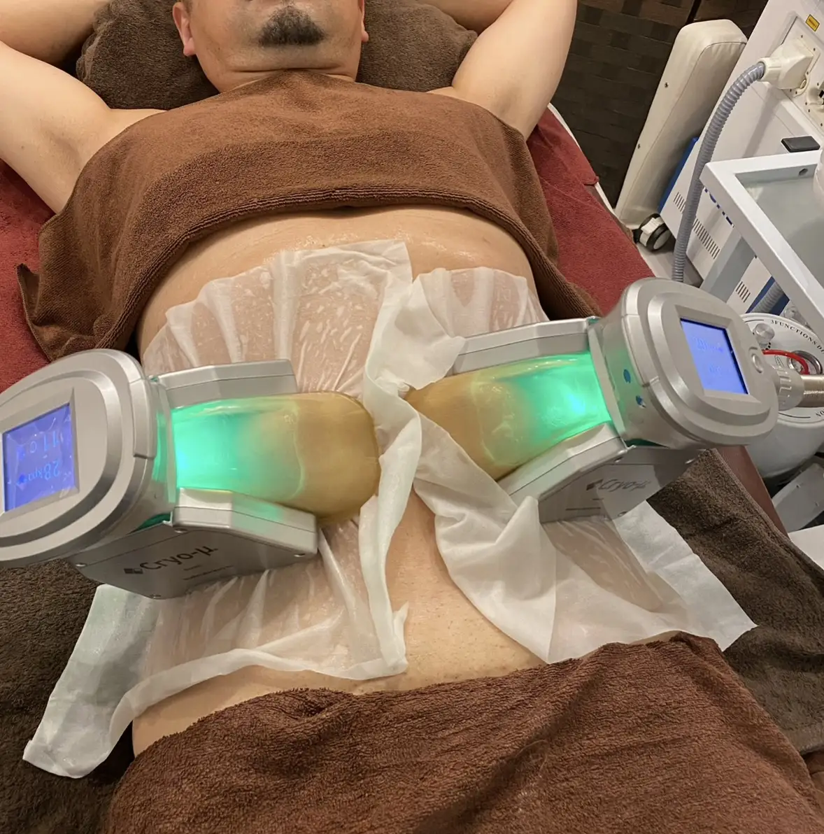 Fat Freezing (Cryo-μ®) – Appease Spa